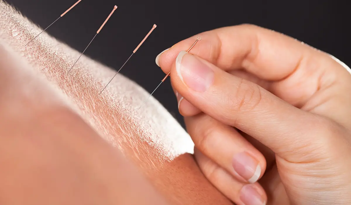 Acupuncture Treatment For CRPS