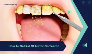 Get Rid Of Tartar On Teeth
